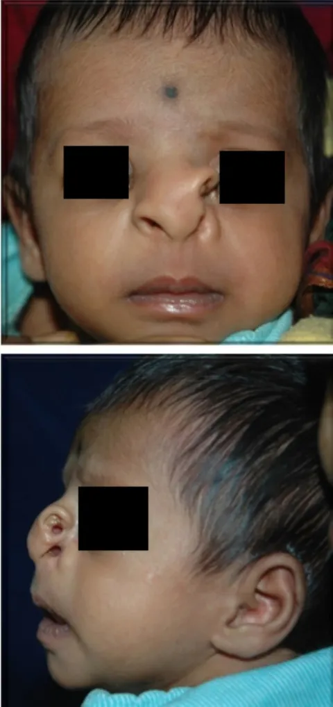 Figure 1: Preoperative clinical photograph showing supernumerary nostril above and lateral to the left nostril with associated medial eyelid coloboma.