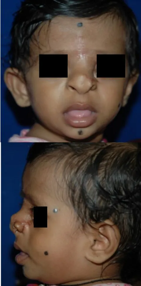 Figure 3: Immediate postoperative appearance after glabellar flap reconstruction.