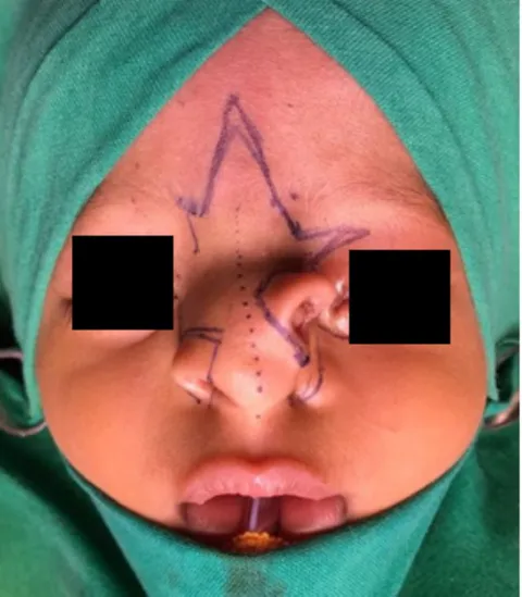 Figure 2: Intraoperative photograph demonstrating markings for excision of accessory nostril and repositioning of alar cartilage.