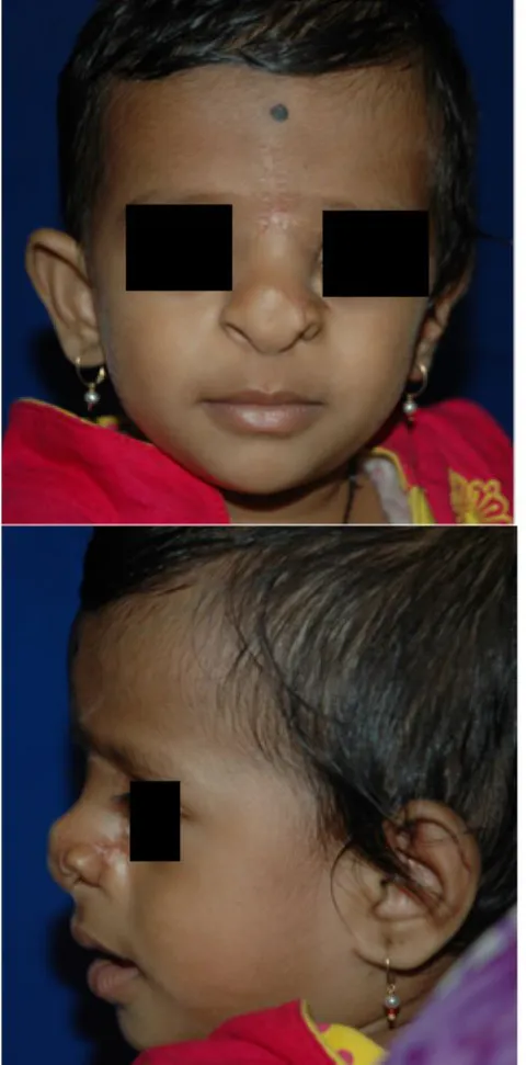 Figure 4: Late postoperative view showing satisfactory nasal contour and symmetry.