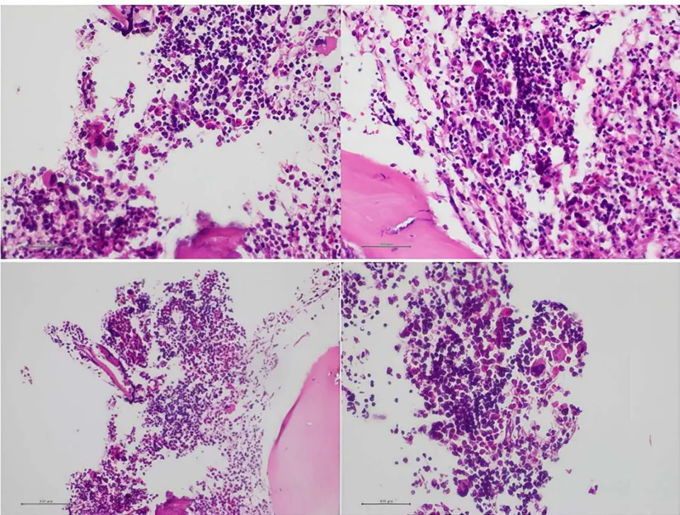 Figure 2: Bone Marrow Biopsy