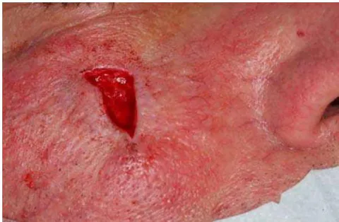 Fig. 13: Scar Excision Intraoperatively. The Gaping of the Wound Edges Due to Centrifugal Scar Traction is Clearly Visible