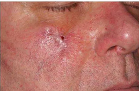 Fig. 14: Multilayer Plastic Wound Closure After Scar Excision