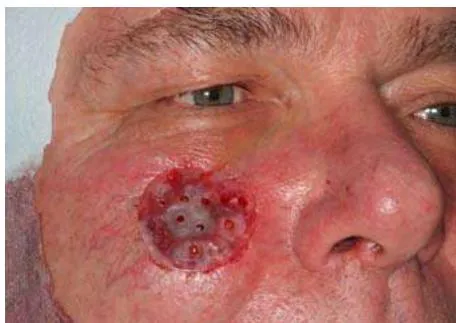 Fig. 9: Cheek Right with the Fixed Dressing Plate