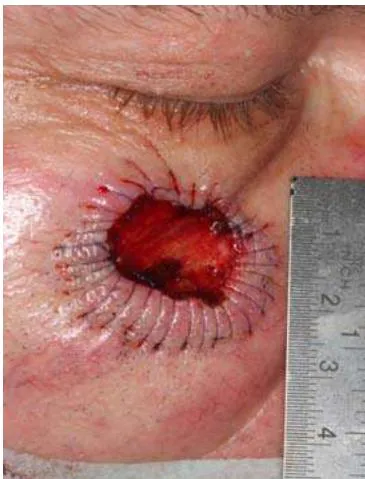 Fig. 4: Resection Defect with 1st Circular, Overlapping Hem Suture