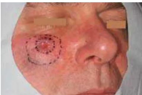 Fig. 2: Right Cheek with Planned Resection