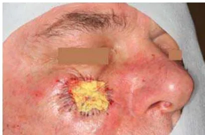 Fig. 5: Covering with a Knotted Bandage Until Histologically Tumor-Free Margins are Secur