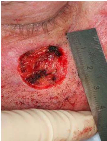 Fig. 3: Resection Defect Intraoperatively