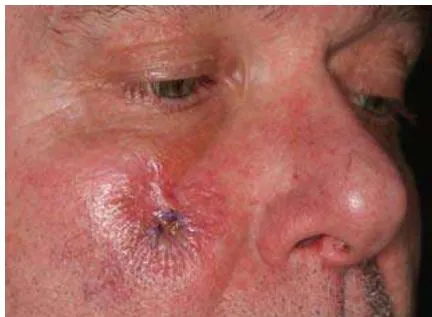 Fig. 11: After Completion of Wound Contraction Fig. 10: State after the 3rd Wound Contraction
