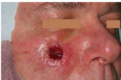 Fig. 6: Wound Defect with Sutured Mucograft Membrane
