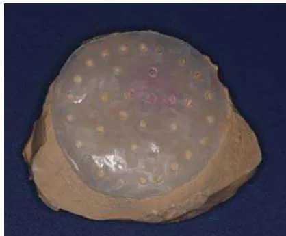 Fig. 8: Dentally Fabricated Dressing Plate with Perforations on the Plaster Cast of the Right Cheek