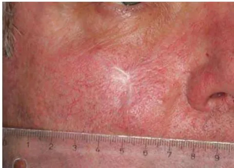 Fig. 12: Healing After Wound Contraction Approx. 10 Months Later