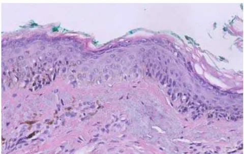 Fig. 1: Histological Confirmation of a Lentigo Maligna