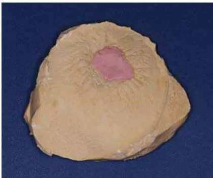 Fig. 7: Plaster Cast of the Wound Defect of the Right Cheek Preoperatively. Blocking Out the Cavity with Pink Modeling Wax