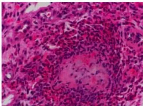 Figura 1: Corte histológico corado pela hematoxilina-eosina e aumento de 40x mostra glomérulo renal com hipercelularidade endocapilar por infiltração de leucócitos. Fonte: Autores (2024)