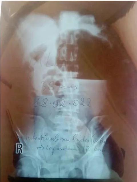 Figure 1: Radiographie de l'abdomen sans préparation d'un patient en occlusion intestinale aiguë montrant des niveaux hydroaériques