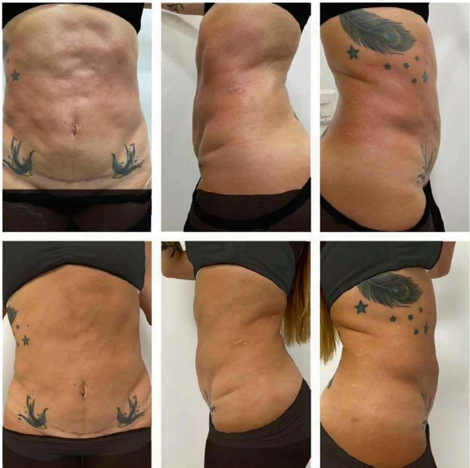 Figure 4: Visual Clinical Changes. A. Before application of pbserum HIGH. B. After forty-five days of a single session of pbserum HIGH a reduction in surface irregularities and improvement in skin uniformity were observed.
