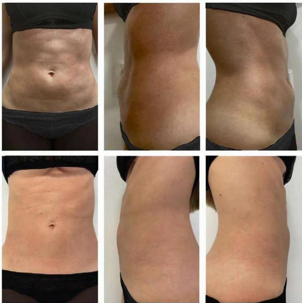 Figure 2: Visual Clinical Changes A. Before the application of pbserum HIGH. B. Forty-five days after a single application of pbserum HIGH, improvements in contour, reductions in fatty deposits, and enhancements in the texture and coloration of the abdominal skin were observed.