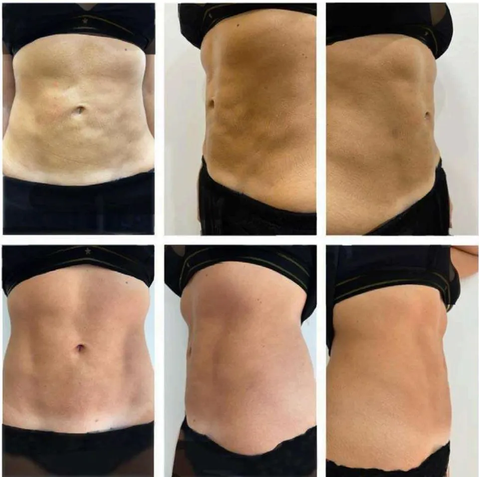 Figure 3: Visual Clinical Changes. A. Before the application of pbserum HIGH. B. Forty-five days after a single application of pbserum HIGH, an improvement in abdominal skin irregularities induced by liposuction was observed.