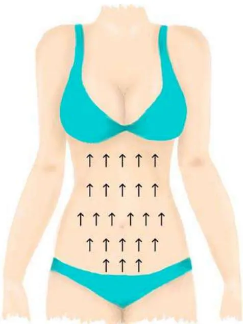 Figure 1: Schematic design of the subcutaneous application of recombinant enzymes in the abdomen through a cephalic vectorization, proposed and recommended by the authors