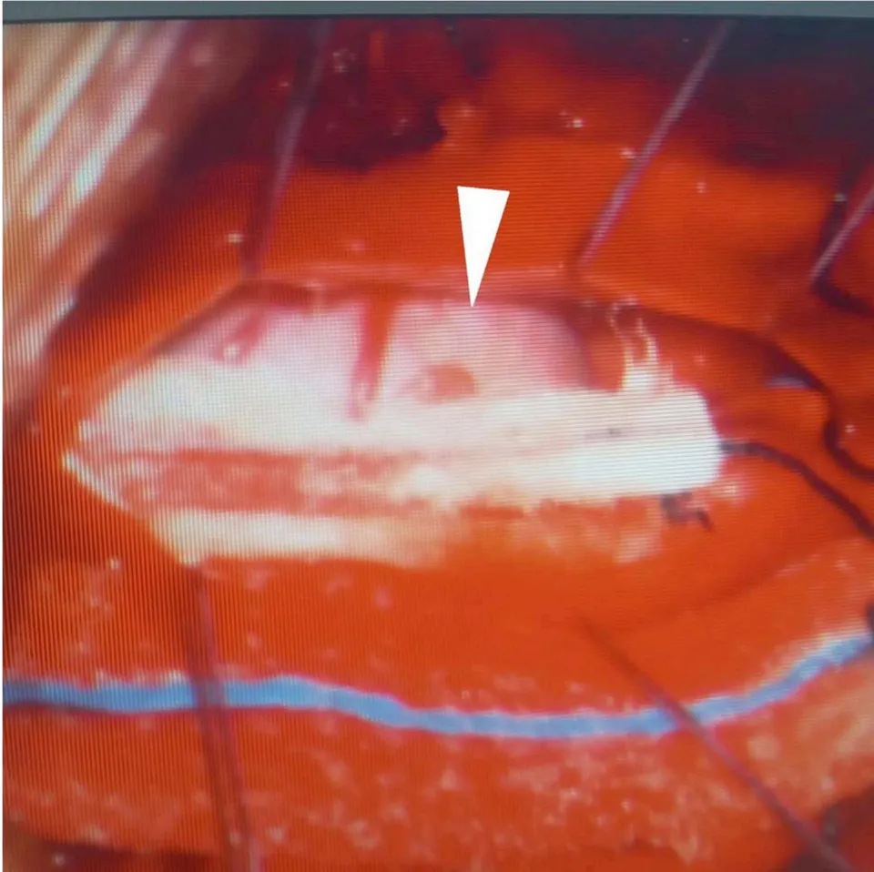 Figure 2: Macroscopic aspect Intra-operative photograph showing a cherry red lesion (arrow) arising from the lower medulla oblongata.