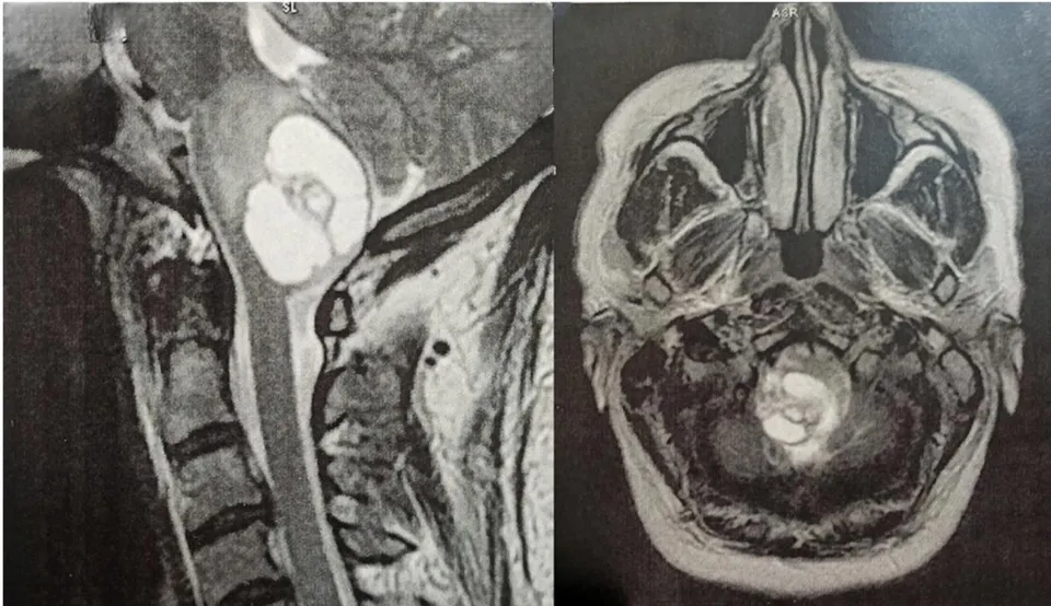 Figure 1: Imagery T2-weighted head MRI on sagittal and axial planes showing an intradural intramedullary cystic lesion located in the caudal part of the fourth ventricle and the dorsal medulla oblangata.