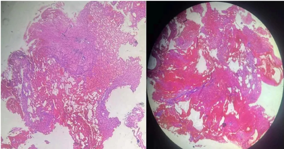 Figure 3: Microscopic aspect Photomicrograph showing features of hemangioblastoma: a highly vascular neoplasm with biphasic tissue composition comprising stromal cells containing abundant foamy vacuolated cytoplasm and capillary networks with large branching vessels, and areas of hemorrhage.