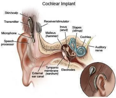 Figure 2: Diagram of a Cochlear Implant from the National Institute of Health (2017)