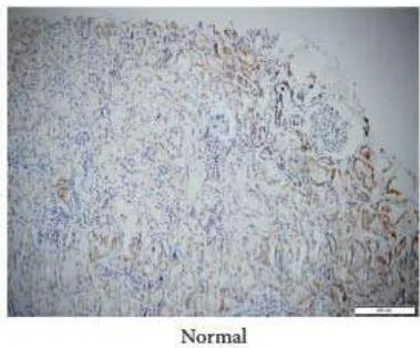 Figure 4: Mesenchymal Markers in Cancerous Tissue Versus Normal Cells (adapted from Li et al) [15]