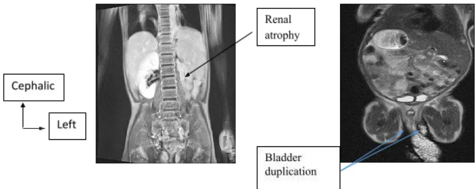Figure 7: MRI Showing Left Renal Atrophy (At Left) And Blader Duplication (At Right)