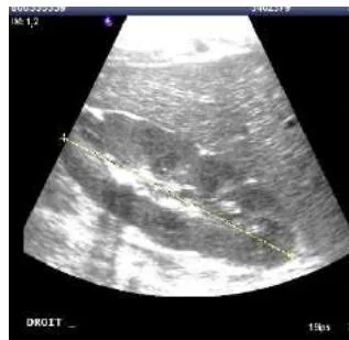Figure 5: Renal anomaly, left kidney atrophy (left) seen on ultrasound, and normal kidney on the right in the same patient