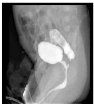 Figure 6: Cystography Showing Left Vesicoureteral Reflux (Vur) And Right Rectourethral Fistula
