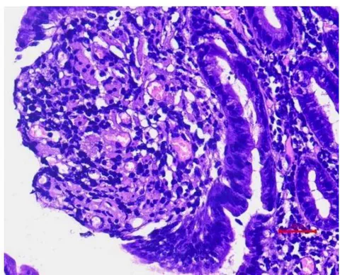 Fig. 7: Lymphoplasmacytic Infiltration in Stomach, H & E, 40X