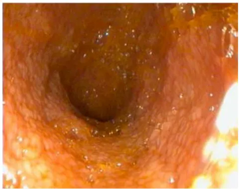 Fig. 5: Increased granularity in duodenal mucosa