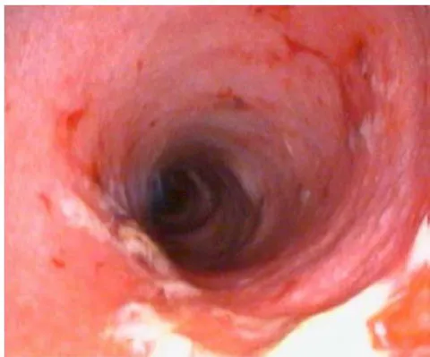 Fig. 4: Friable and Hemorrhagic Gastric Mucosa