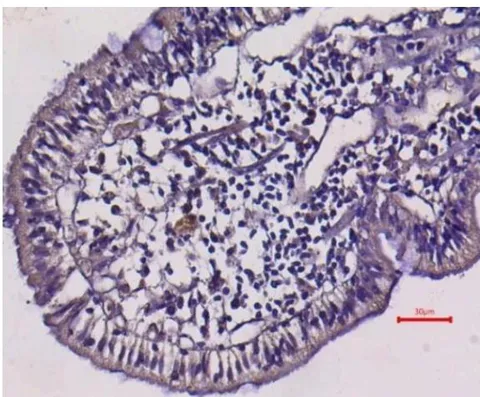 Fig. 8: Strongly Positive CD3 Cells Intraepithelial Lymphocytes of Duodenum, H & E, 40X Fig. 9: Strongly Positive Ki 67 in Lamina Propria of Colon, H & E 40x
