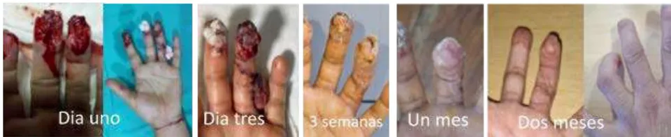 Fig. 3: Lesión de la punta de los dedos tratada con colgajo cross finger. *POP: postoperatorio Fig. 4: Lesión de la punta de los dedos tratada con colgajo en isla (cuarto dedo)