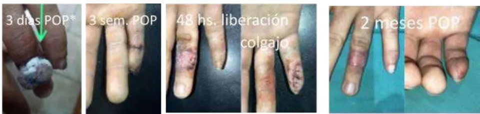 Fig. 2: Lesión de la punta de los dedos tratada con colgajo de avance V-Y