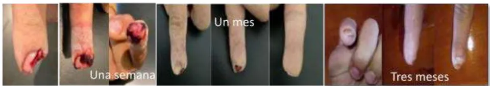 Fig. 1: Lesión de la punta de los dedos tratada con apósito de sujeción intravenoso