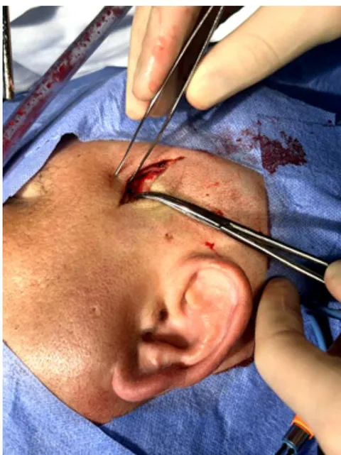 Figure 4: Intraoperative Image-Incision and drainage of the zygomatic collection on the left