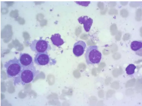 Figure 1: Abnormal Plasma Cells Revealed by Sternal Puncture